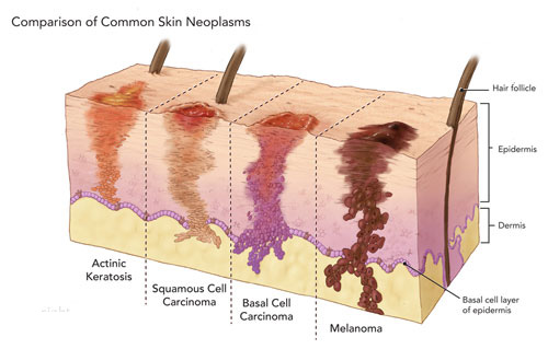 Опухоли и новообразования кожи