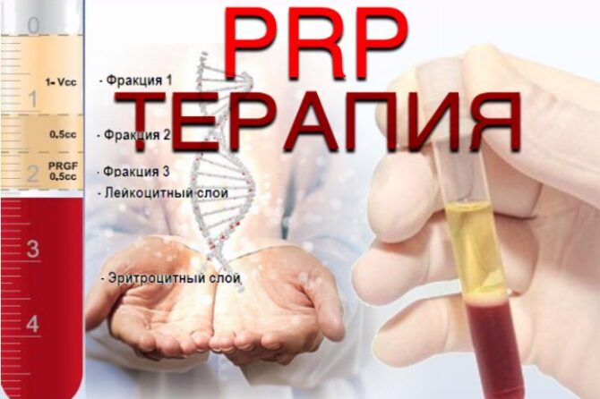 PRP-терапия